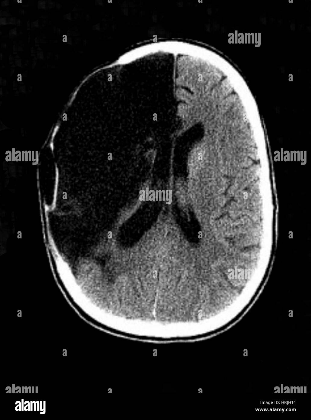 Maladies du cerveau, scanner Banque D'Images