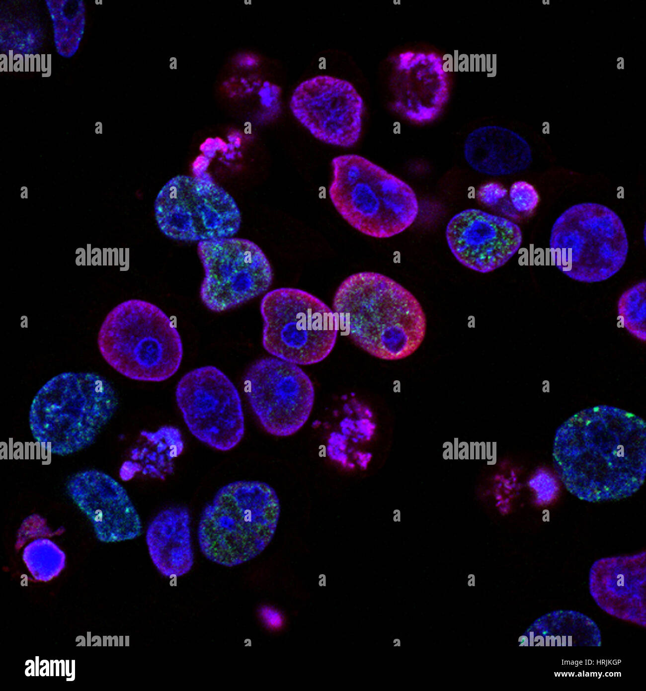 Les cellules de cancer colorectal endommagé par RTA, FM Banque D'Images