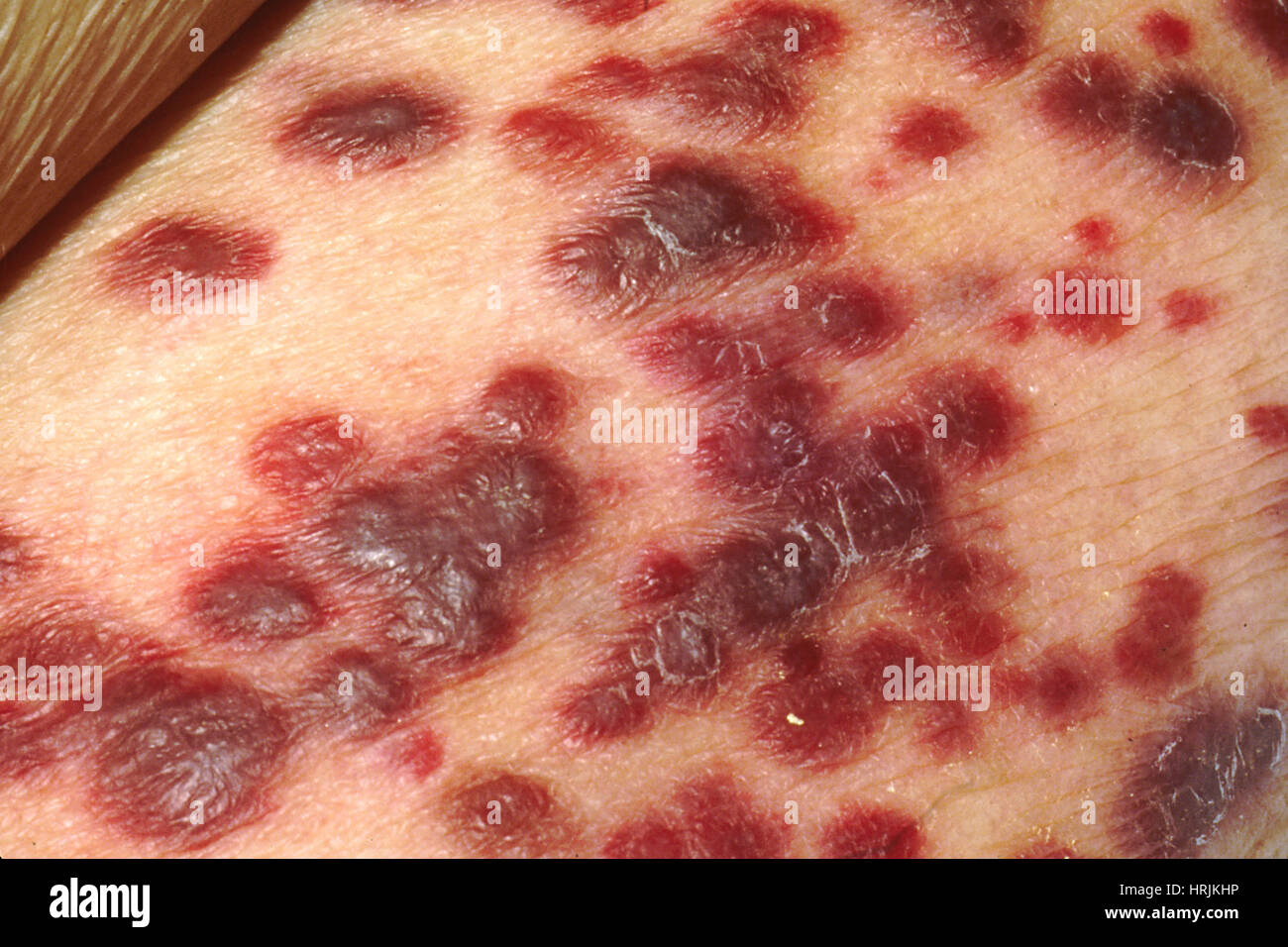 Sarcome De Kaposi Malade Du Sida Photo Stock Alamy Sarcome De Kaposi Malade Du Sida Photo Stock Alamy
