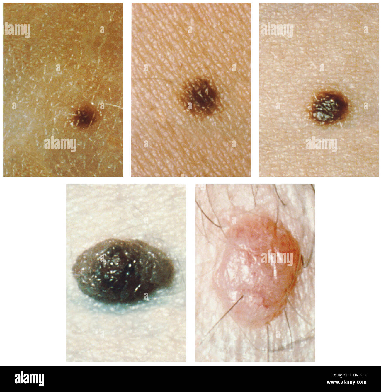 Naevus, grains de beauté Photo Stock Alamy