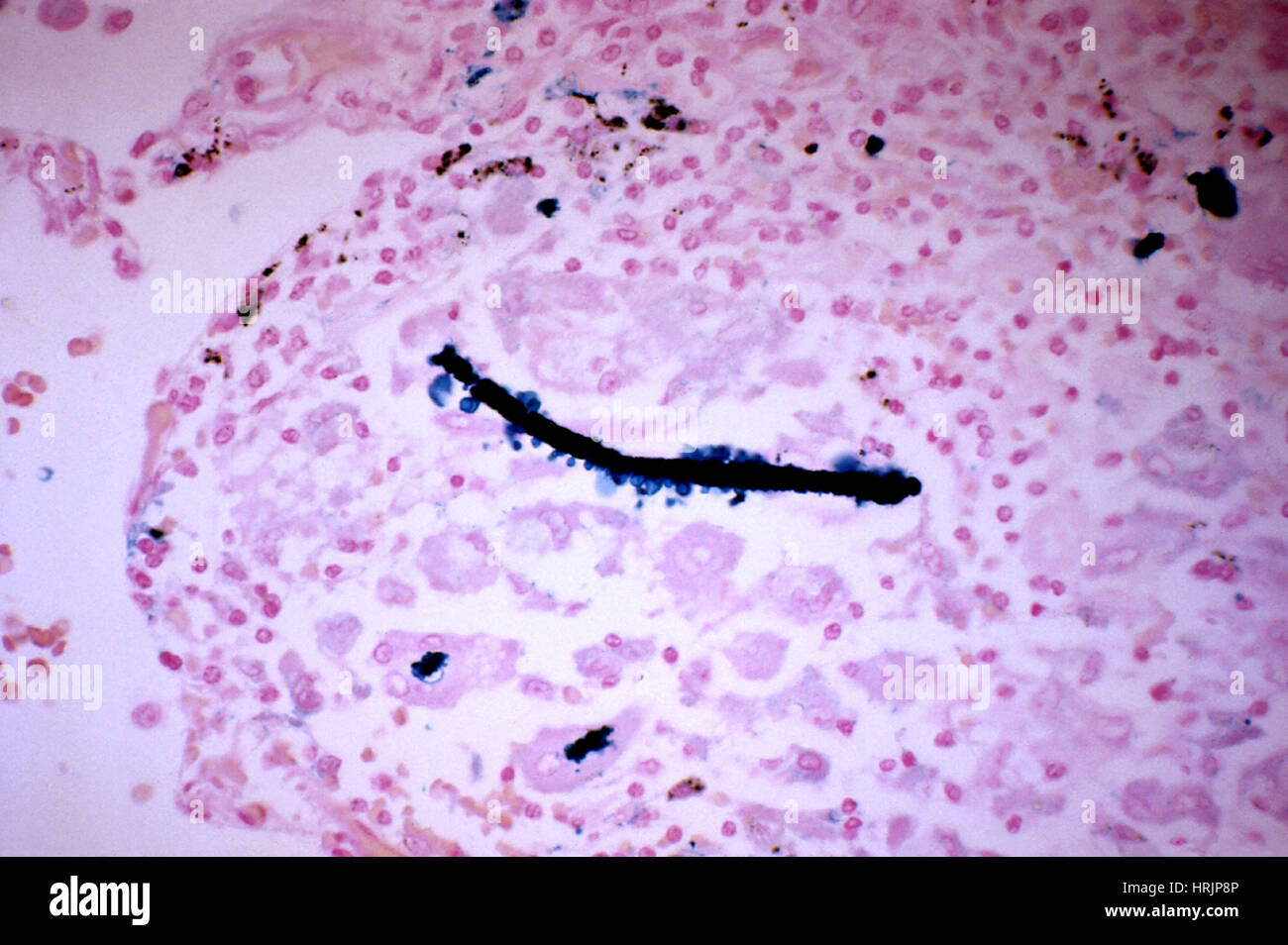 L'amiante dans le tissu pulmonaire, LM Banque D'Images