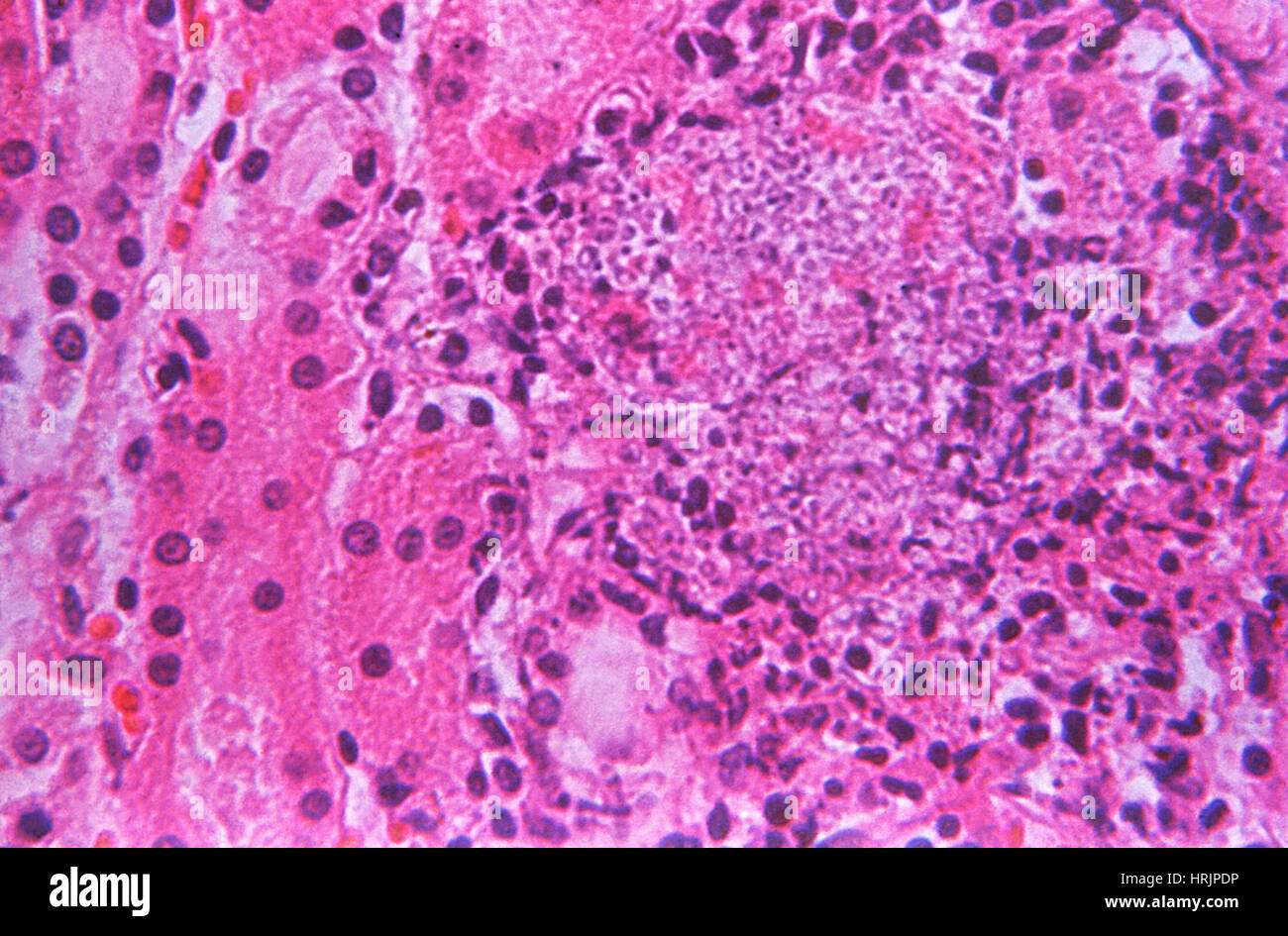 Candida albicans, infection fongique, LM Banque D'Images