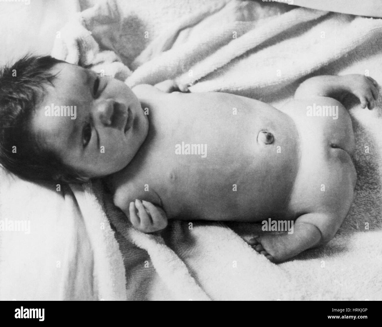 Bebe De La Thalidomide Photo Stock Alamy