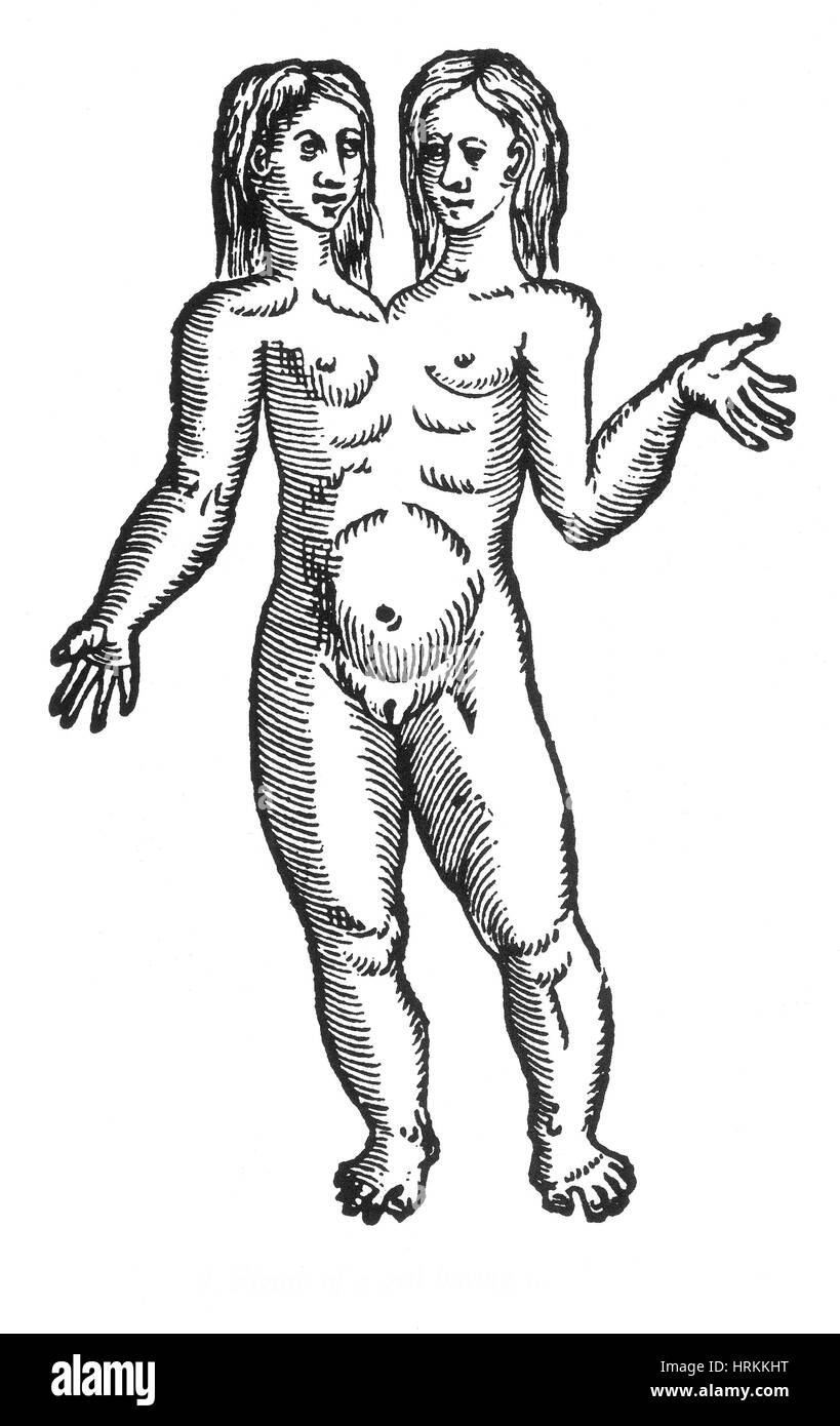 Parapagus jumeaux siamois, 16e siècle Banque D'Images