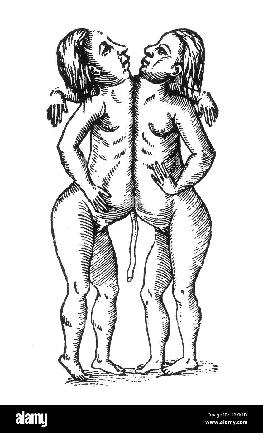 Thoracopagus jumeaux siamois, 16e siècle Banque D'Images