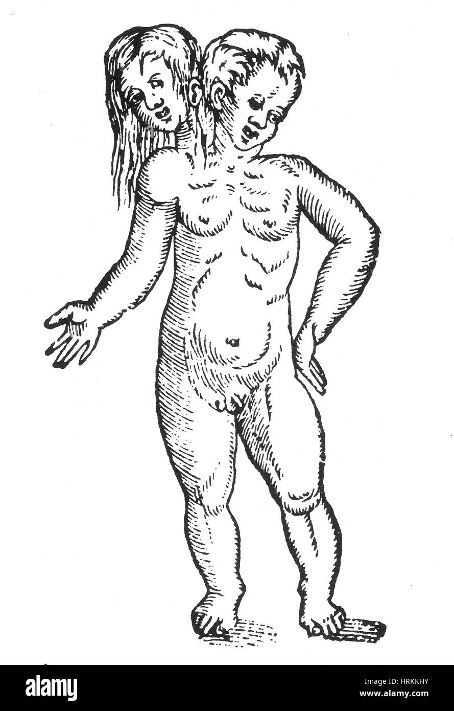 Parapagus jumeaux siamois, 16e siècle Banque D'Images