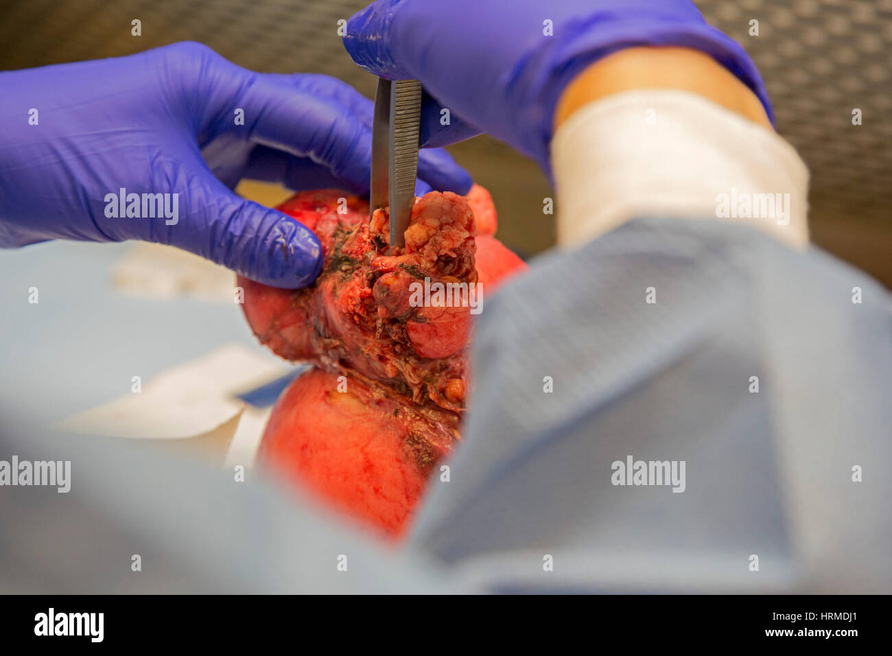 Detroit, Michigan - un assistant de pathologie au Detroit Medical Center examine un utérus avec un adénocarcinome endométrial. Banque D'Images