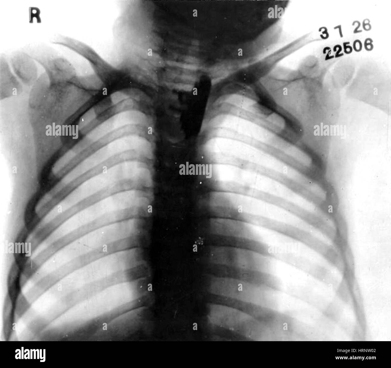 X-Ray de bibelots d'ingestion par l'enfant, 1933 Banque D'Images