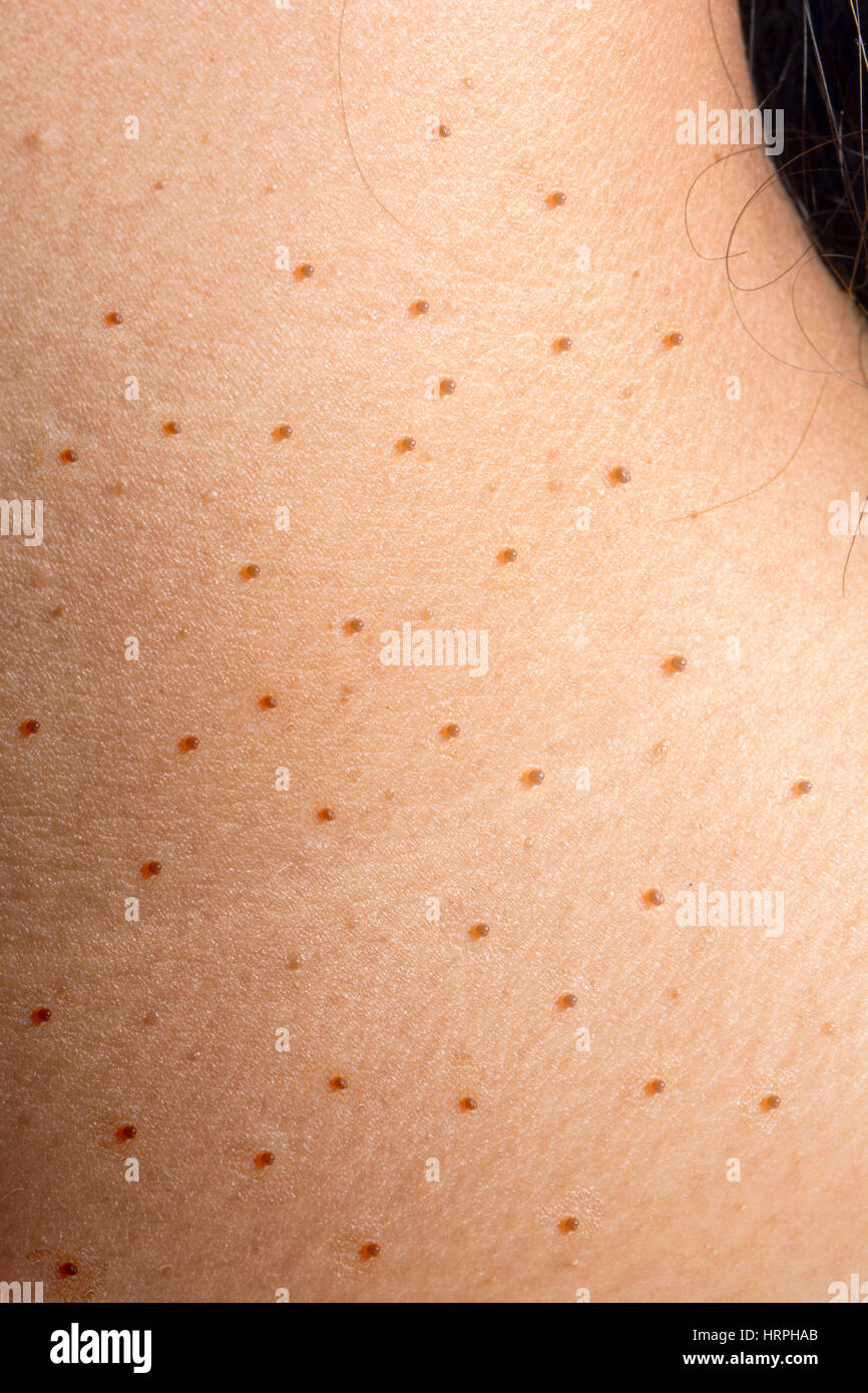 La verrue ou dermatite sur les femmes la peau du cou Banque D'Images