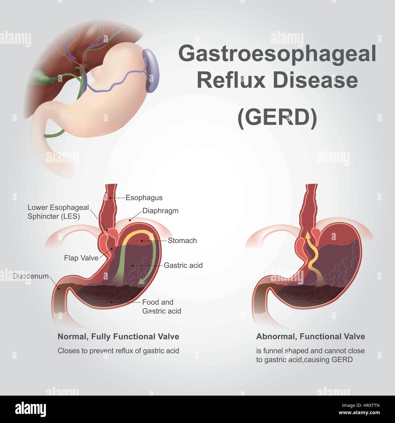 La maladie Gastroesophageal de reflux (GERD), également connu sous le nom de reflux acide, est