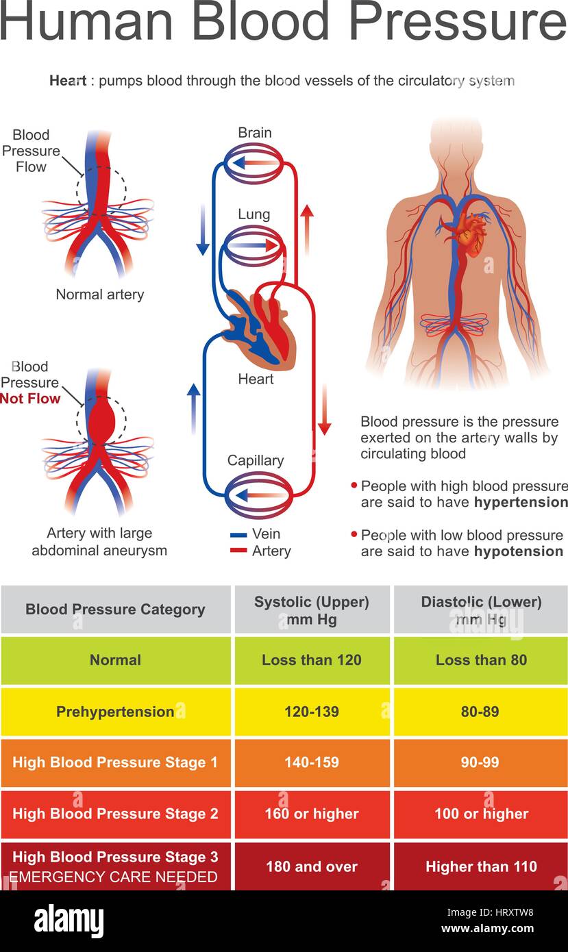 La pression artérielle est la pression du sang circulant sur les parois des vaisseaux sanguins. Lorsqu'il est utilisé sans autre spécification, 'hypertension' usua Illustration de Vecteur