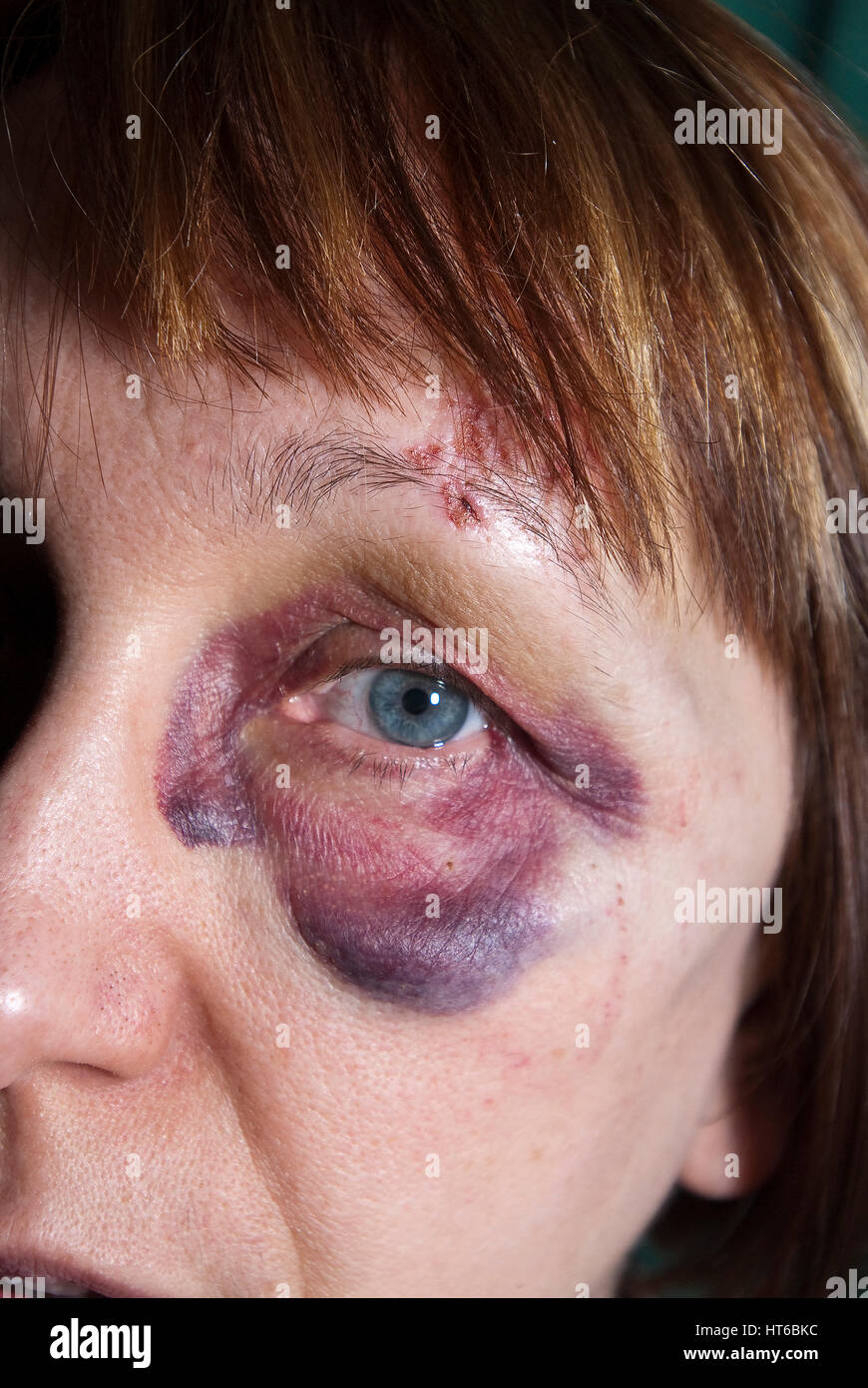 Yeux visage noir hématome Banque D'Images