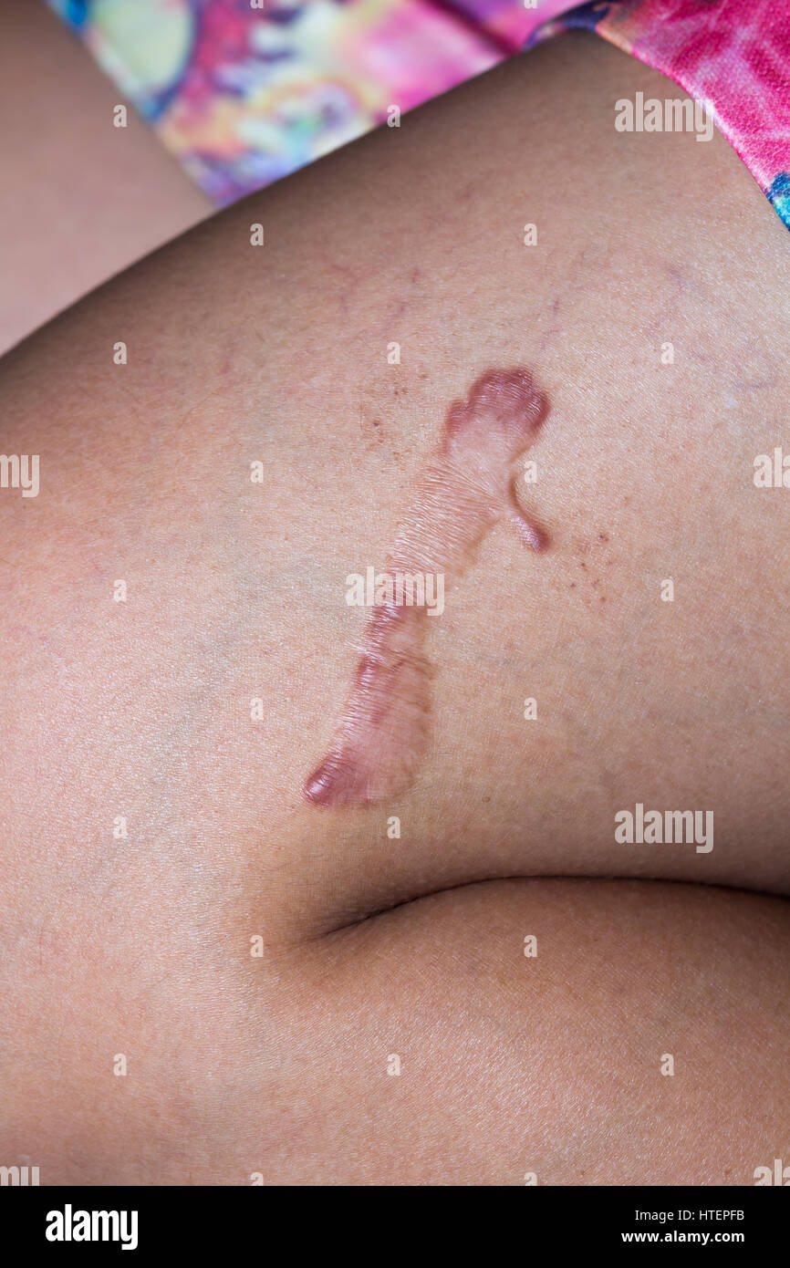 Cicatrices sur sa jambe Photo Stock - Alamy