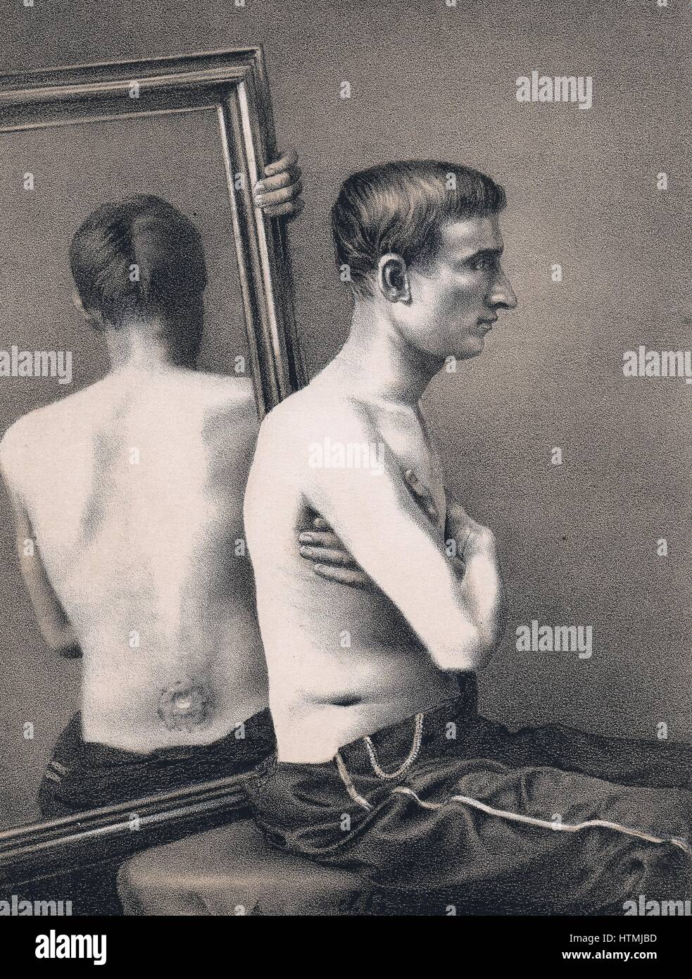 Le Lieutenant Diechler le 10 août sur la sortie de l'hôpital après la récupération de balle à l'abdomen reçues à Hatcher's Run en mars. À partir de la 'Circulaire No.6', Surgeon General's Office, Washington, 1 novembre, 1865. Lithographie teintée Banque D'Images