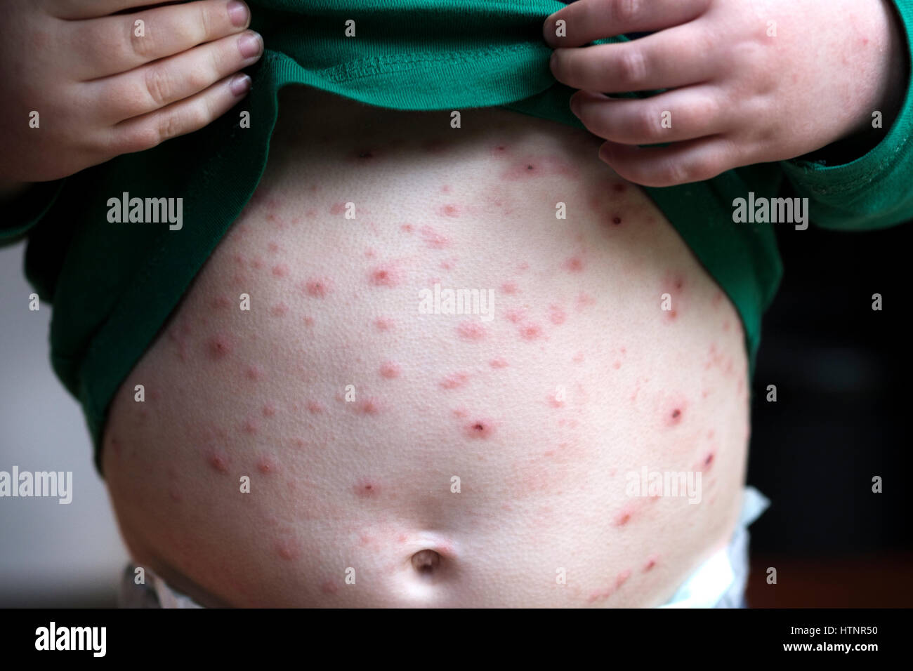 Un petit enfant infectés par le virus de la varicelle varicelle ...