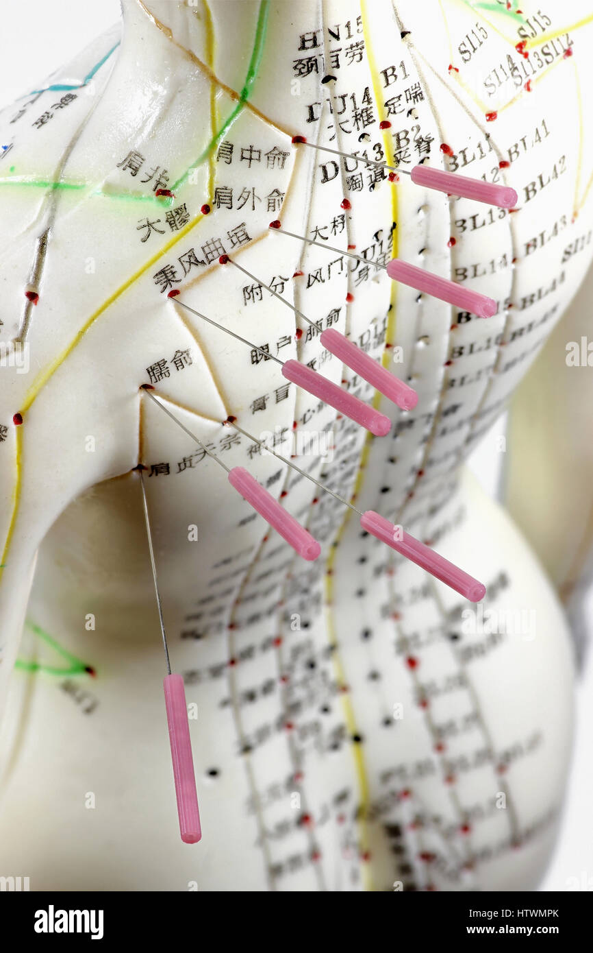Modèle d'acupuncture femme avec des aiguilles dans l'épaule Banque D'Images
