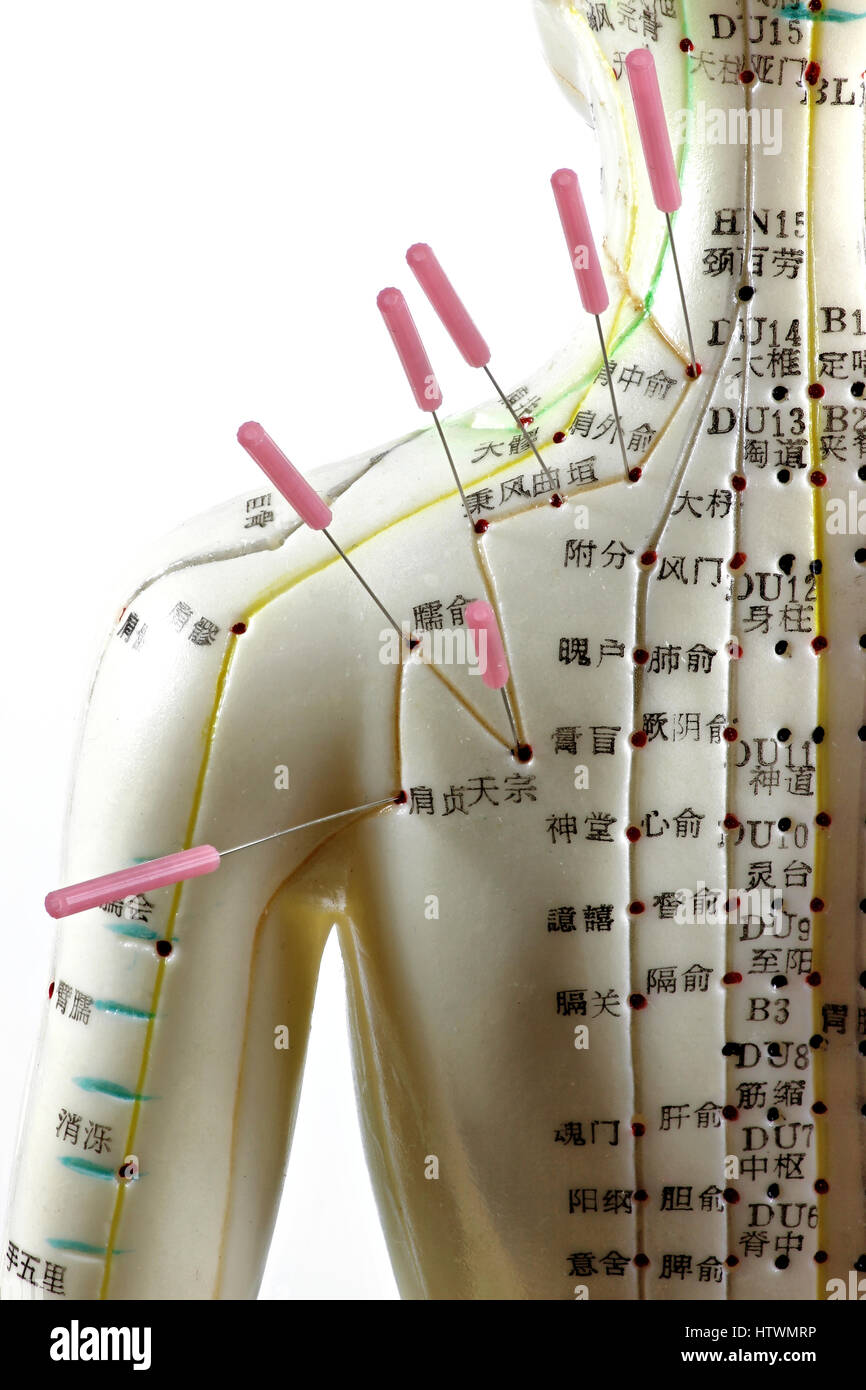 Modèle d'acupuncture femme avec des aiguilles dans l'épaule Banque D'Images