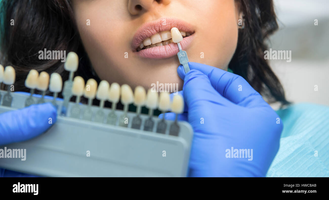 Blanchiment des dents du patient et graphique. Banque D'Images