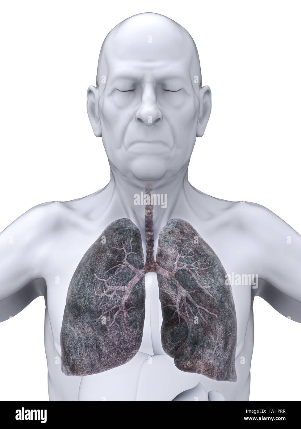 Des hommes âgés d'un cancer du poumon Illustration Banque D'Images