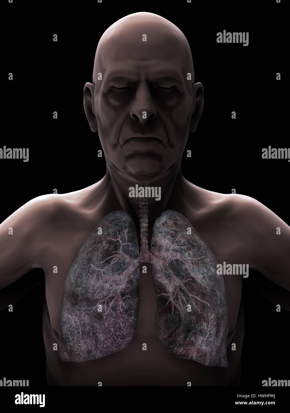 Des hommes âgés d'un cancer du poumon Illustration Banque D'Images