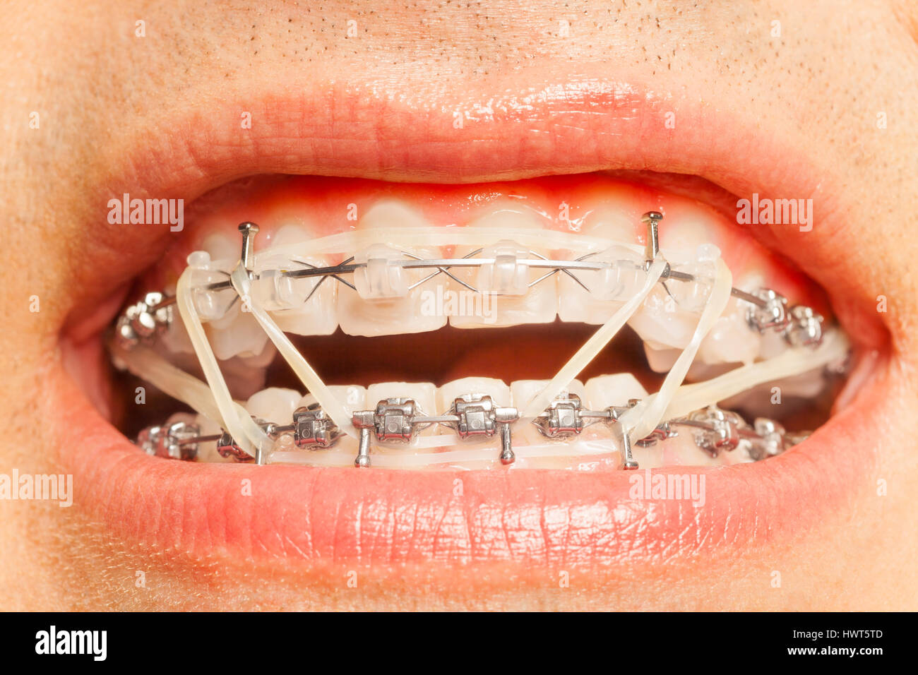 Appareil dentaire avec joints toriques sur la correction orthodontique Banque D'Images