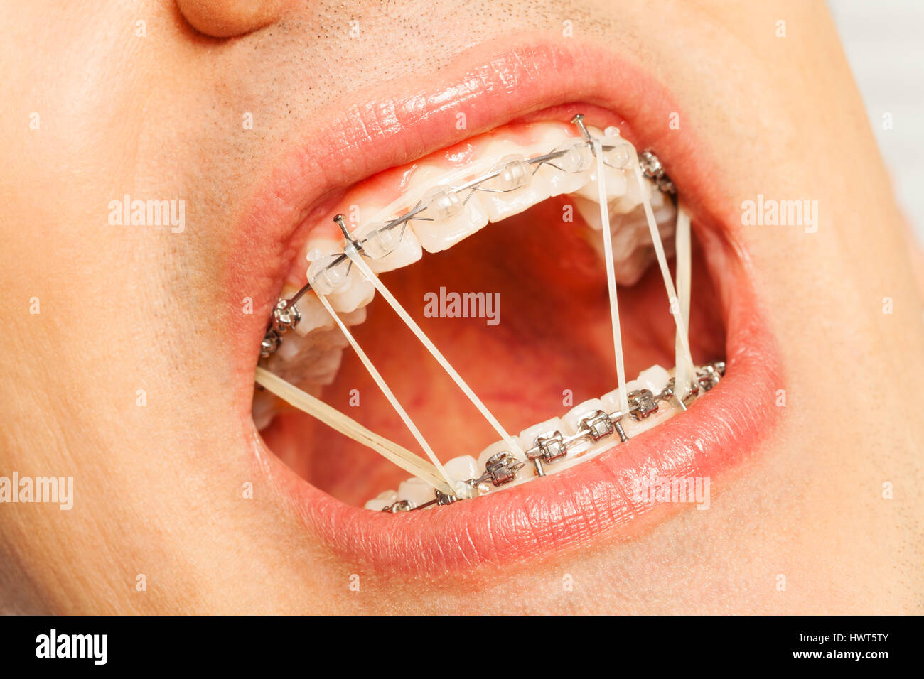 Ouvrir la bouche de l'homme avec les accolades et les anneaux d'orthodontie Banque D'Images