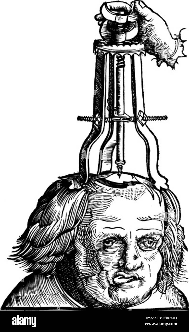 L'élévation d'une fracture du crâne déprimée est une procédure chirurgicale critique utilisée pour traiter les blessures au crâne. Le processus consiste à soulever soigneusement les fragments osseux pour les remettre en place afin de soulager la pression et d'empêcher d'autres dommages au cerveau. Banque D'Images