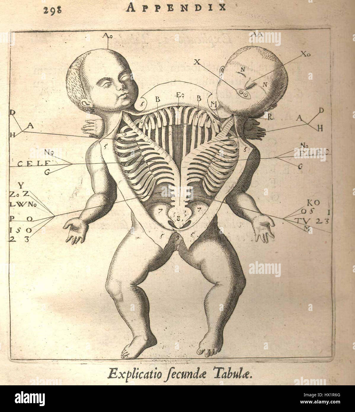 La 'Twin dissection' de Fortunio Liceti est une illustration médicale historique qui démontre une dissection de jumeaux conjoints. Cette œuvre, datant du XVIIe siècle, reflète la curiosité scientifique de l’époque, montrant les subtilités anatomiques de rares conditions humaines. Le travail de Liceti a contribué aux premières études de la biologie et de l'anatomie humaines pendant la Renaissance. Banque D'Images