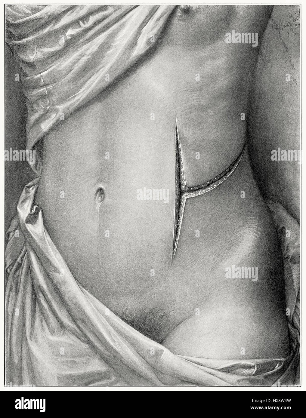 L'incision rénale en forme de T est une technique chirurgicale utilisée dans les procédures rénales, permettant l'accès à la région rénale pour divers traitements médicaux. Banque D'Images