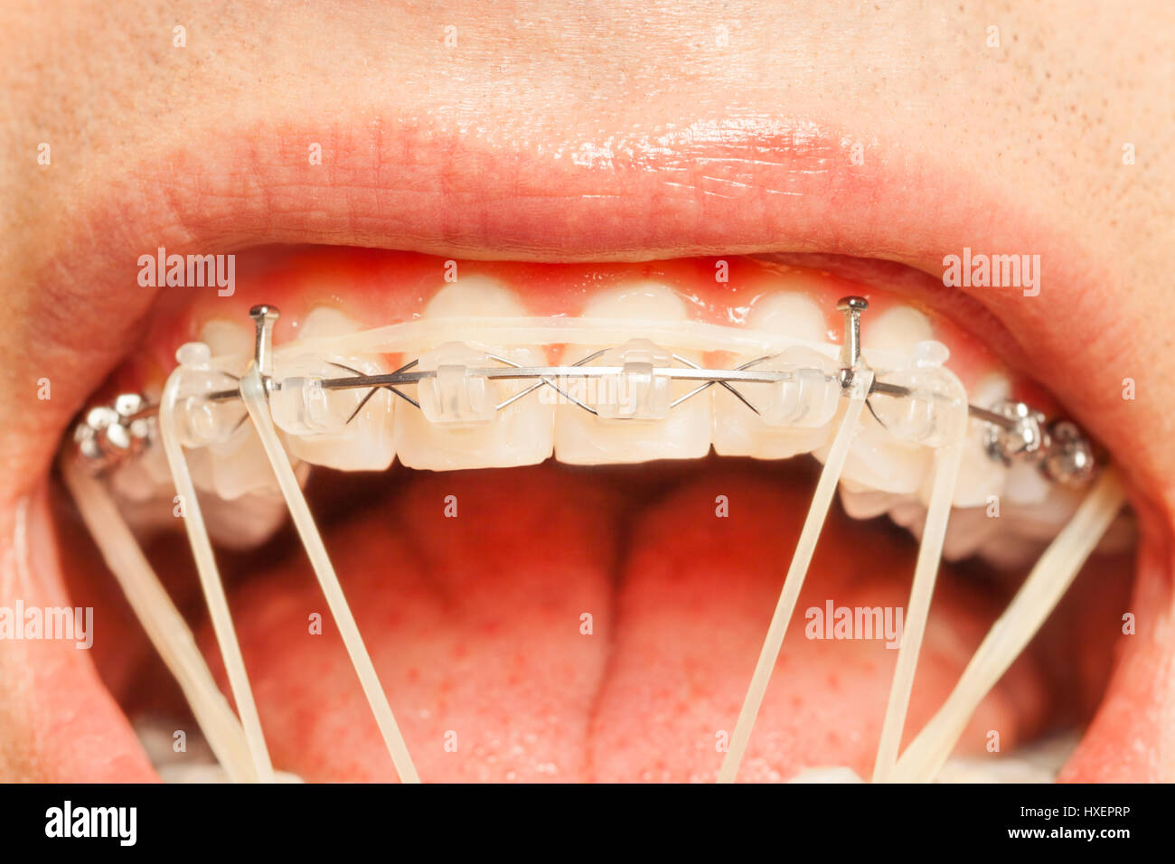 Libre de dents du haut, l'appareil dentaire en caoutchouc avec correction  et crochets installés pour changer la position des mâchoires Photo Stock -  Alamy