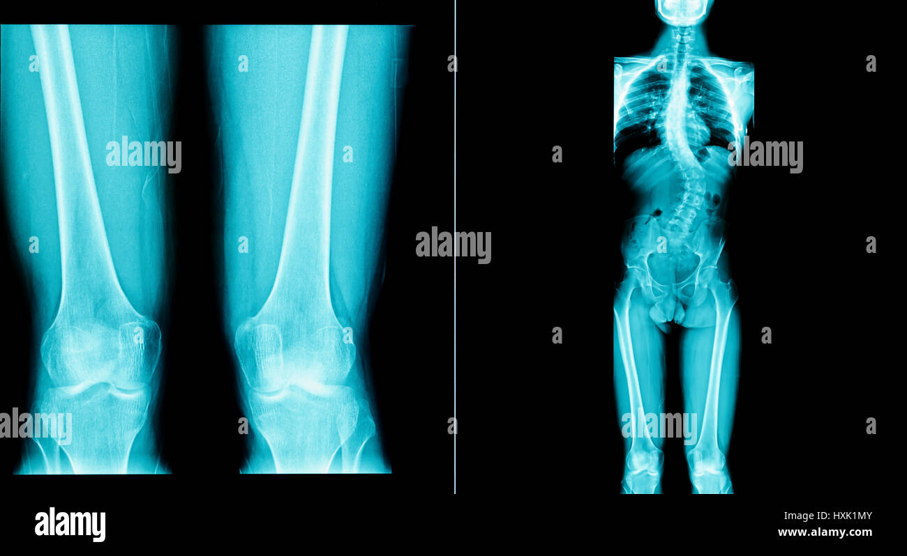 X-ray image des droits de l'avoir un os long corps Banque D'Images