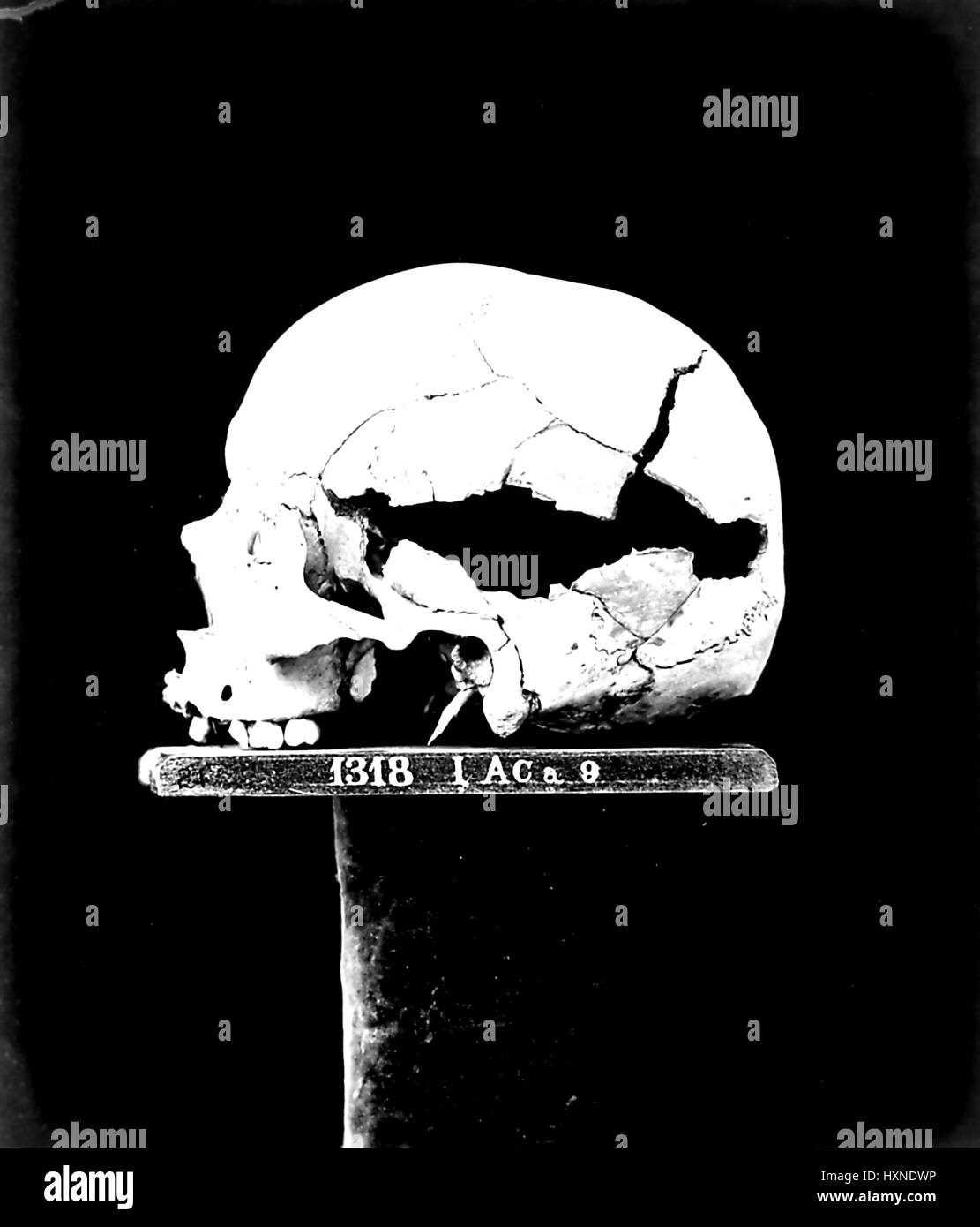 La vie encore médicale représentant le crâne endommagé d'un soldat de la guerre civile, aux blessures subies à l'os du crâne, 1865. Banque D'Images