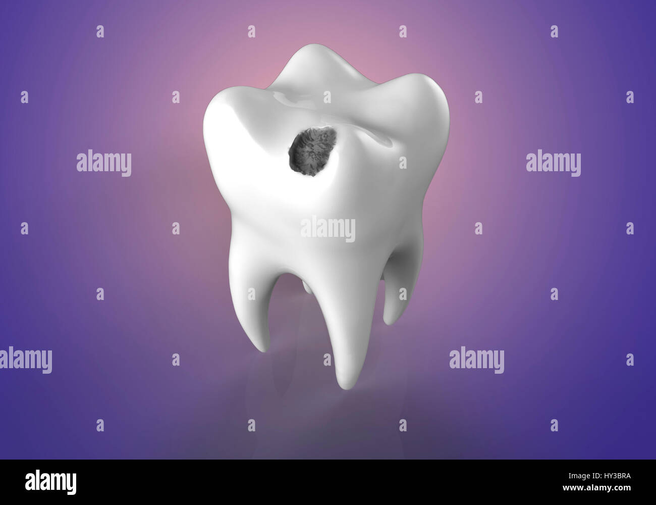 La carie dentaire. Illustration d'ordinateur d'une dent avec une cavité. Banque D'Images