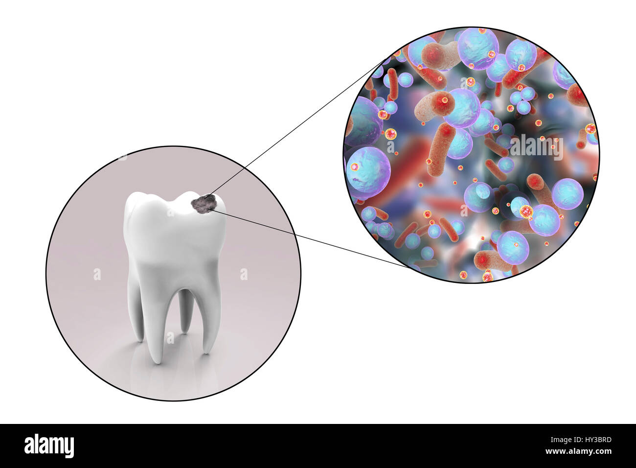 La carie dentaire. Illustration d'ordinateur d'une dent avec une cavité et une vue rapprochée de la bactérie à l'origine de la formation de caries. Banque D'Images