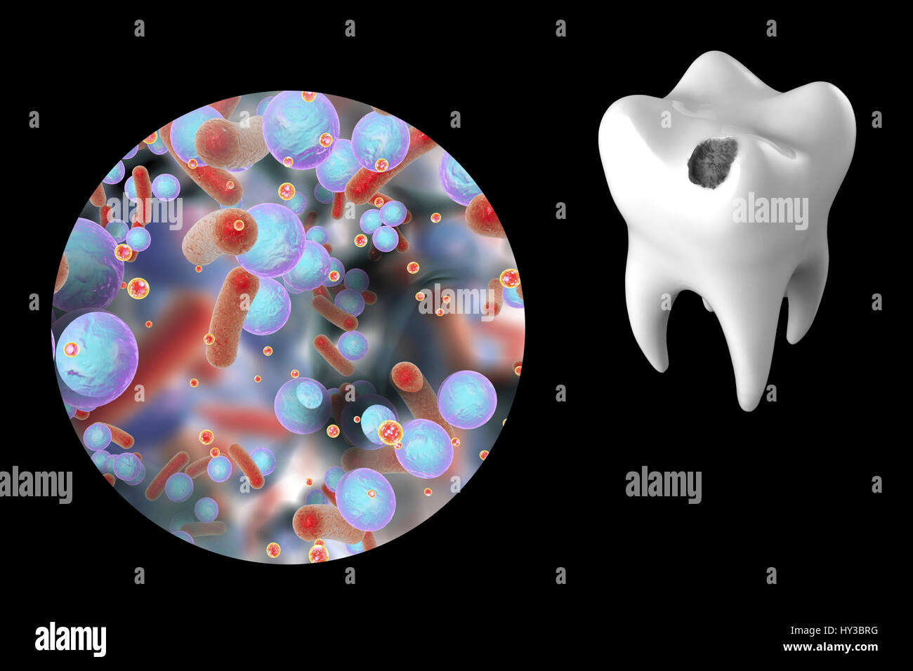 La carie dentaire. Illustration d'ordinateur d'une dent avec une cavité et une vue rapprochée de la bactérie à l'origine de la formation de caries. Banque D'Images