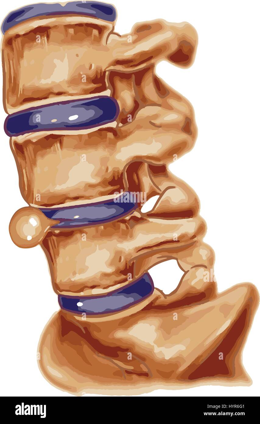 La moelle épinière sous pression de gonflement disc Illustration de Vecteur