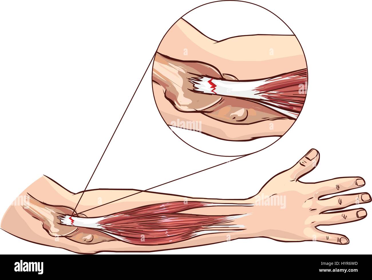 Tennis Elbow - déchirure au tendon extenseur commun du bras Illustration de Vecteur