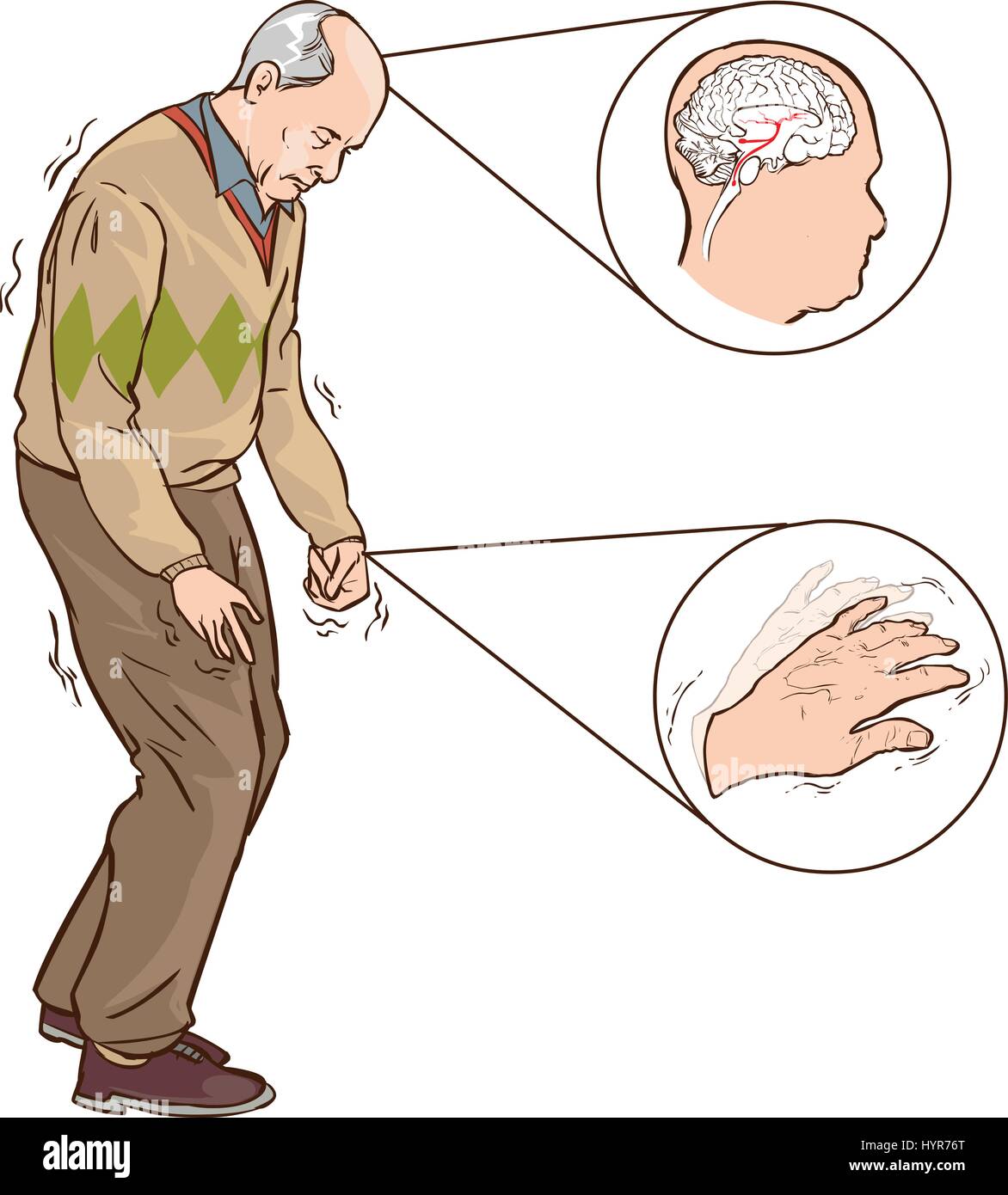 Illustration vecteur de concentration old man avec symptômes parkinson marche difficile Illustration de Vecteur