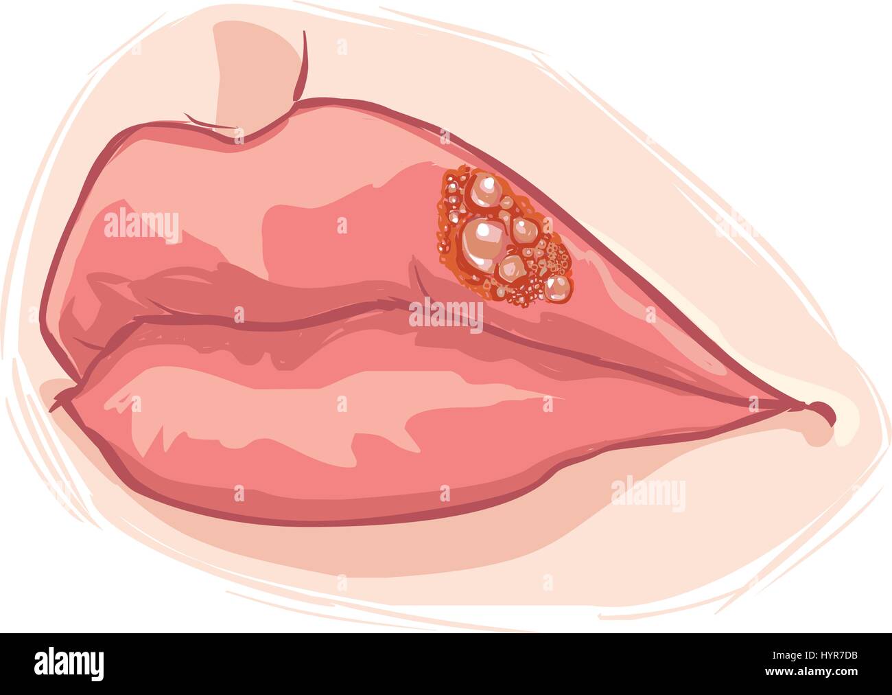 Fond blanc vector illustration d'une lèvre d'herpès Illustration de Vecteur