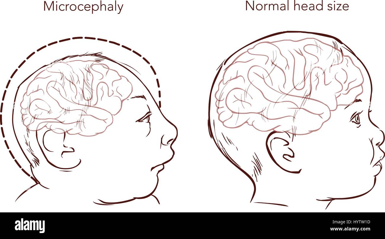 Illustration d'un nouveau-né avec microcéphalie maladie causée par le virus Zika Illustration de Vecteur
