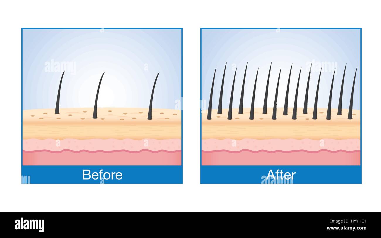Nombre de cheveux sur le cuir chevelu avant et après le traitement de la perte de cheveux. Illustration de Vecteur