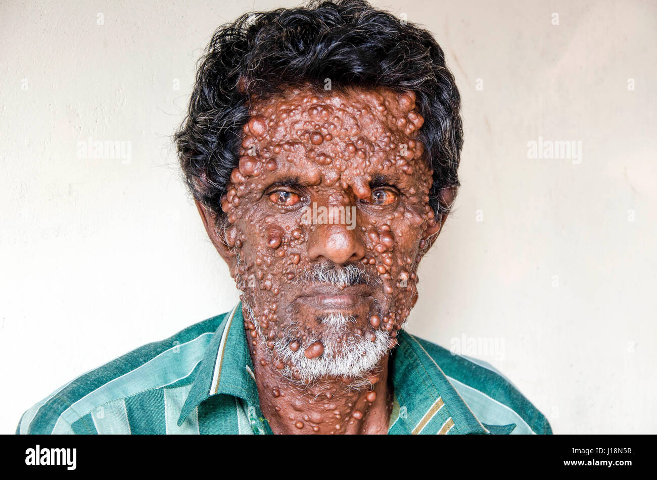 Homme avec gros furoncles sur le visage, Kochi, Kerala, Inde, Asie Banque D'Images