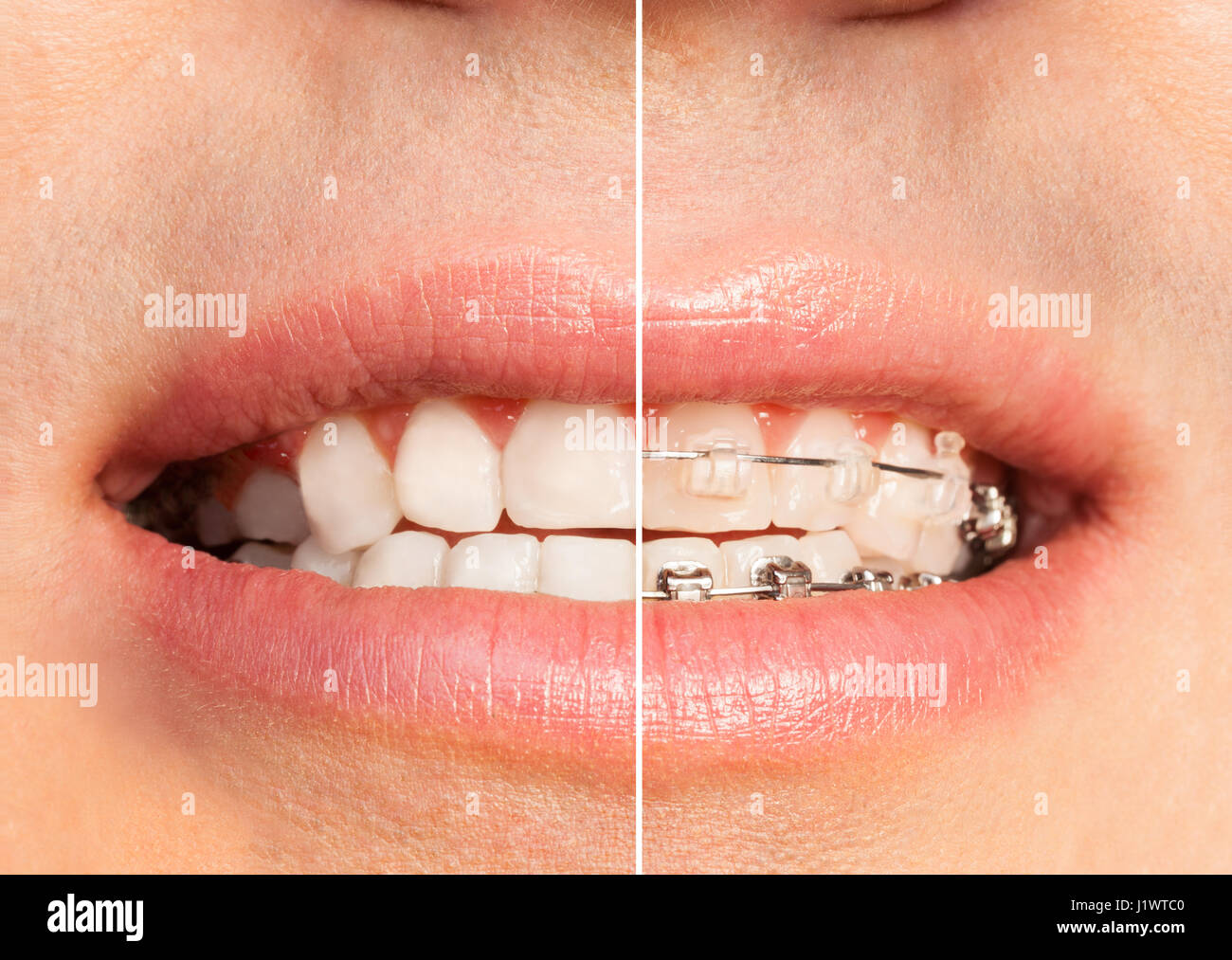 Vue fractionnée de l'homme avec et sans appareil dentaire libre de droit de la bouche complète. Banque D'Images
