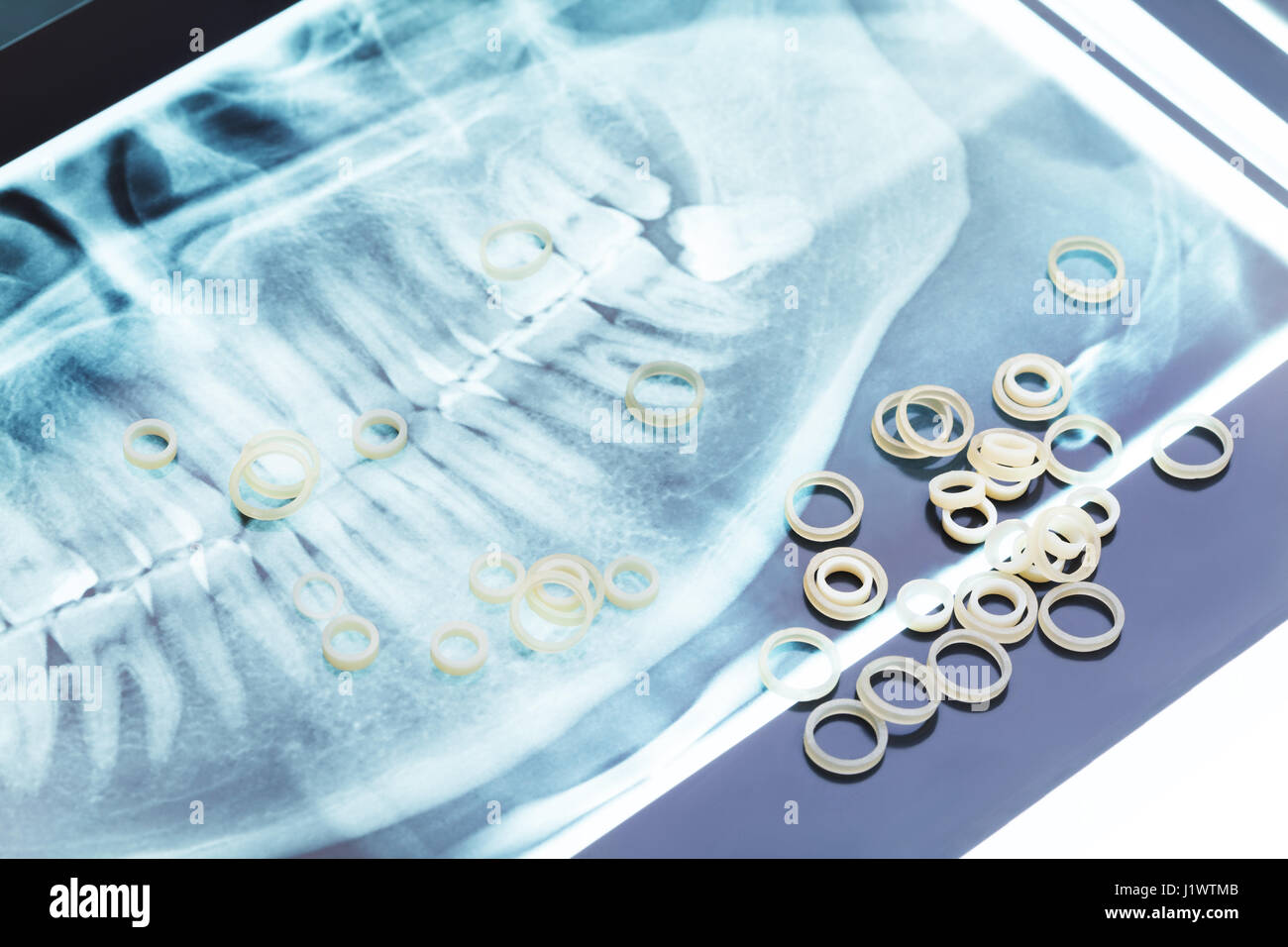 Des cercles de latex d'orthodontie qui met sur jaw xray pour accolades Banque D'Images