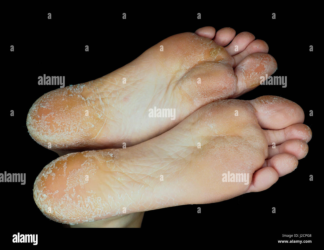 Peeling de la peau de la part des deux pieds côte à côte, sur la personne adulte Banque D'Images