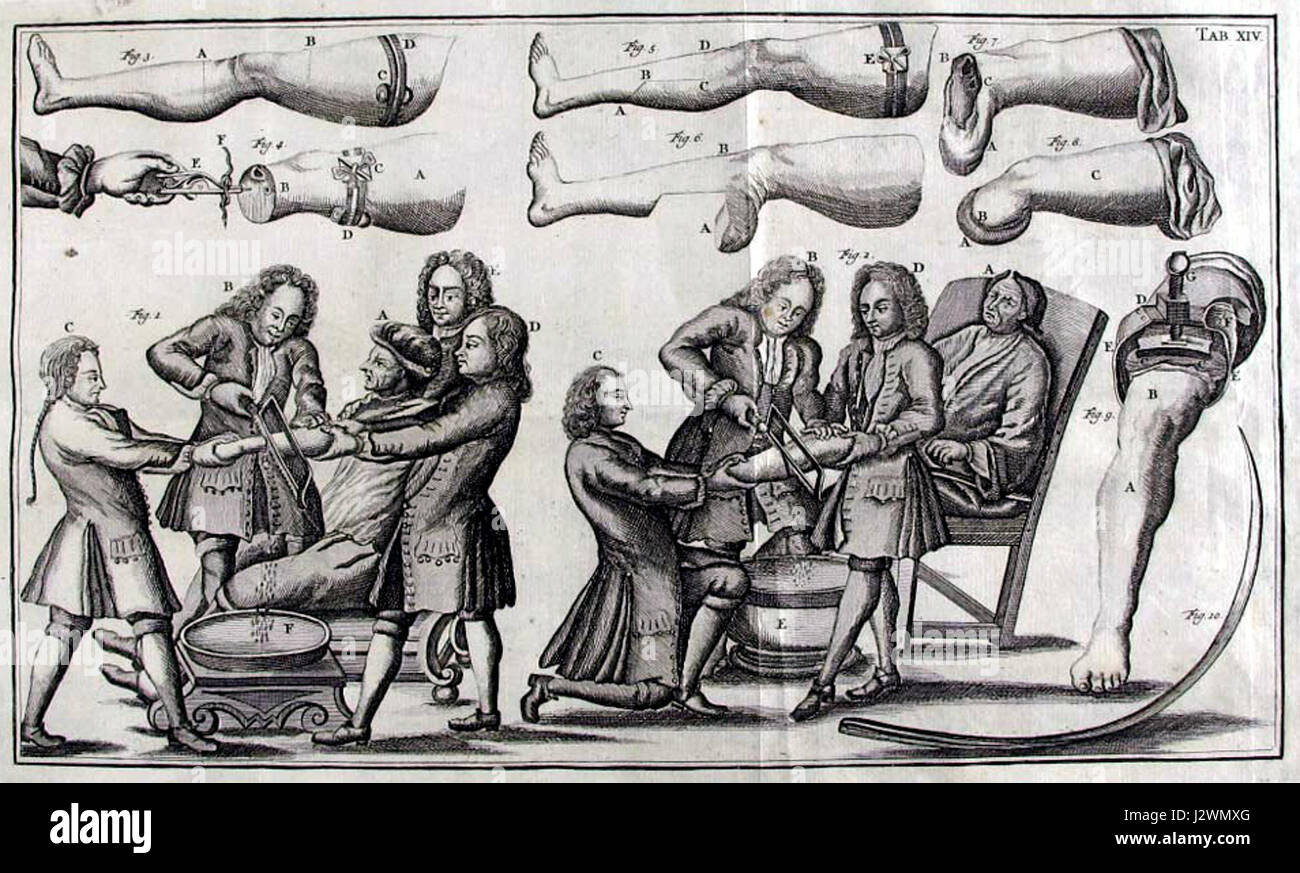 Cette image ou référence représente une procédure ou un événement médical lié à des amputations au XVIIIe siècle. Il met en lumière les pratiques chirurgicales, les techniques et les défis rencontrés au cours de cette période, en particulier en ce qui concerne la guerre, les blessures et les traitements médicaux. Banque D'Images