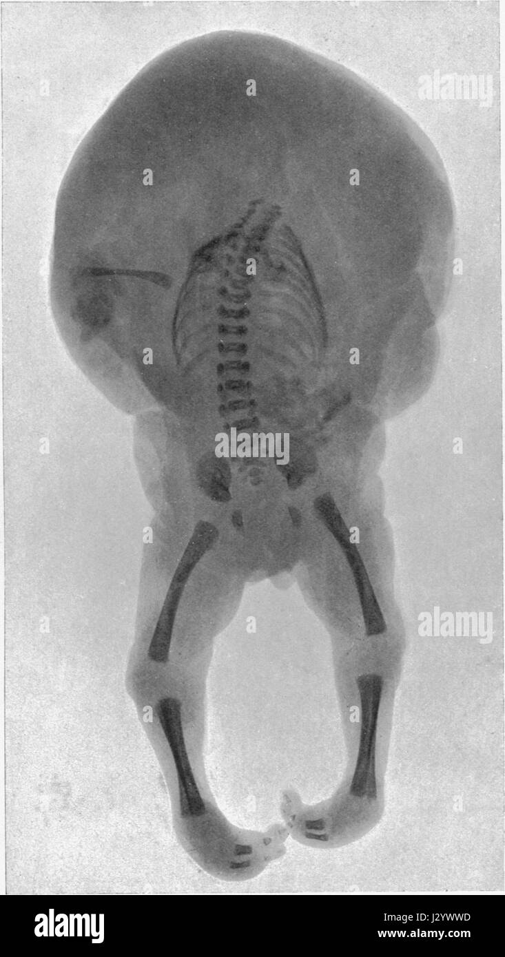 Acarien se réfère à un terme médical décrivant l'absence d'un cœur fonctionnel chez un fœtus en développement, conduisant souvent à une fausse couche ou à une mortinaissance. Ce terme est utilisé dans les études médicales et les diagnostics liés aux conditions congénitales et à la santé fœtale. Banque D'Images