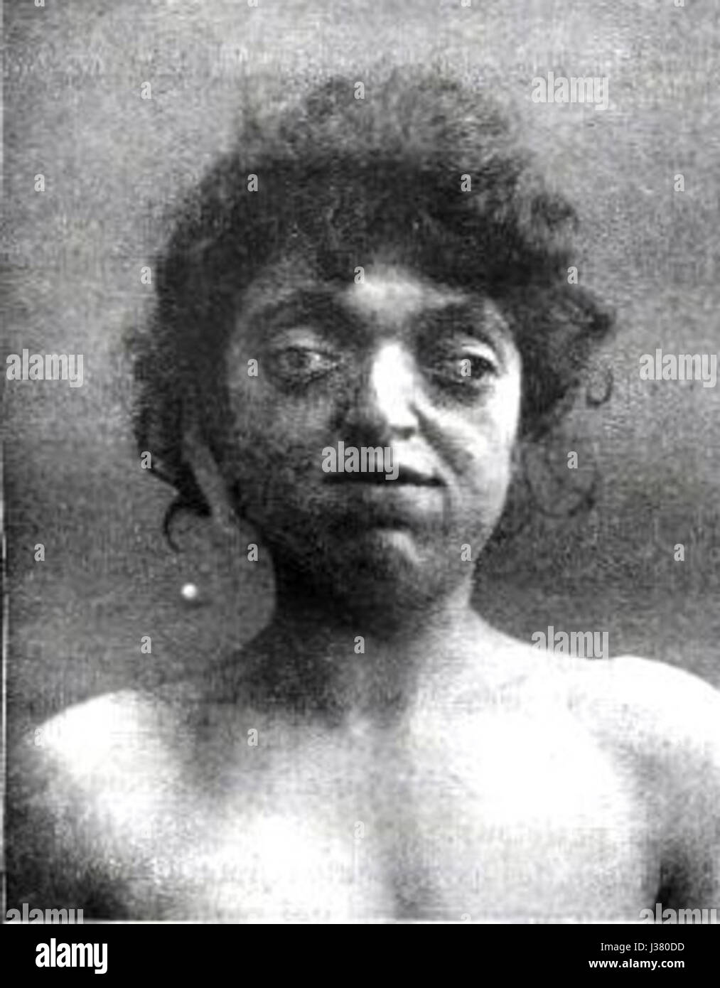 Le syndrome de Crouzon est une maladie génétique caractérisée par la fermeture précoce des sutures dans le crâne, conduisant à des anomalies faciales. C’est une affection rare nécessitant souvent une intervention chirurgicale. Banque D'Images