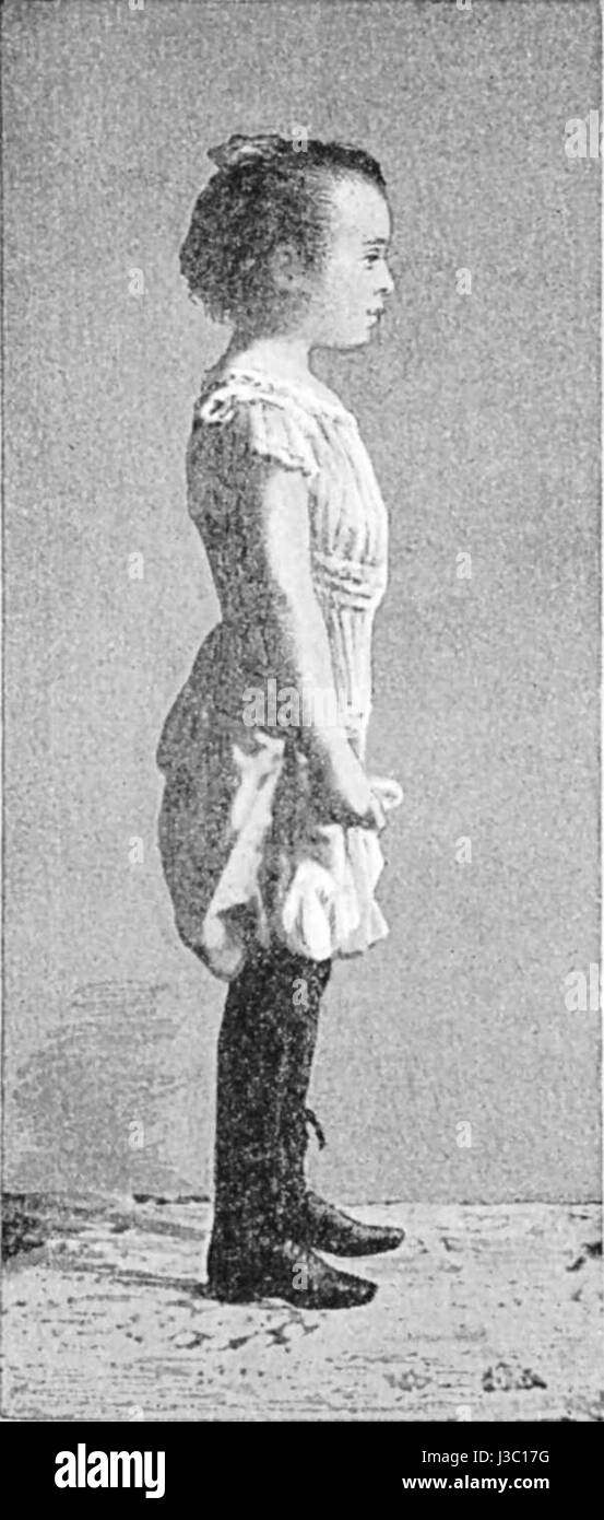 Cette photographie représente un enfant de neuf ans portant un corset abdominal Gach-Sarraute. Ce dispositif médical a été utilisé pour traiter les affections abdominales et post-chirurgicales, mettant en valeur les pratiques médicales historiques. Banque D'Images