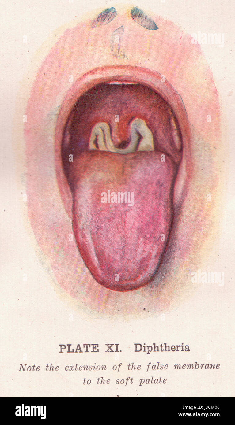 La diphtérie est une infection bactérienne hautement contagieuse causée par *Corynebacterium diphtheriae*. Elle affecte principalement la gorge et peut entraîner de graves complications si elle n'est pas traitée. La vaccination a considérablement réduit son incidence. Banque D'Images